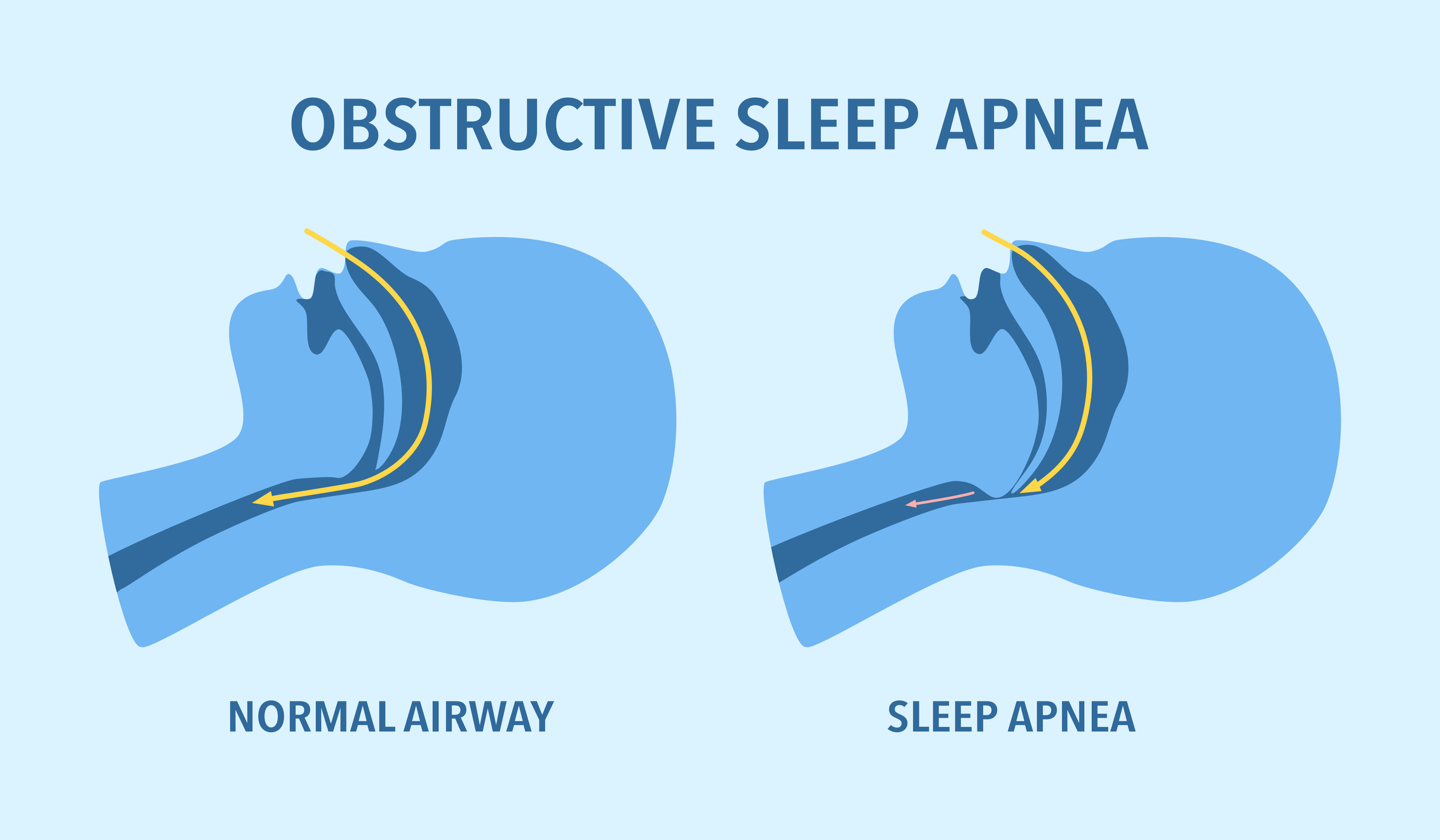 New Technology For Treating Sleep Apnea St Lukes Ear Nose And Throat Associates Inspire